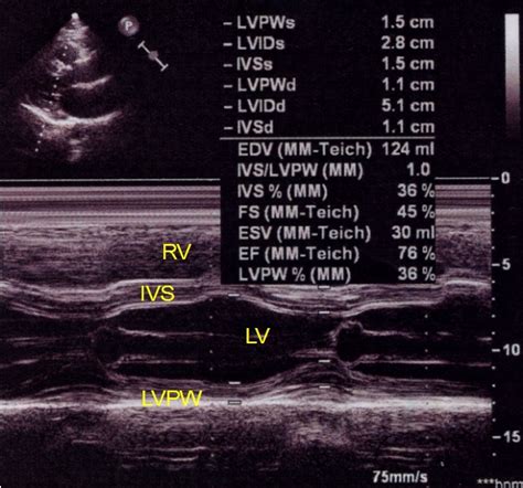 2d echo validity period|Validity of Echocardiographic Measurement in an Epidemiological .